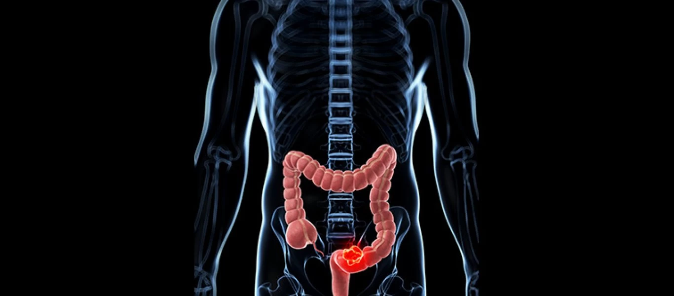 Αυτά είναι τα τρόφιμα και τα φάρμακα που μειώνουν τον κίνδυνο καρκίνου του παχέος εντέρου